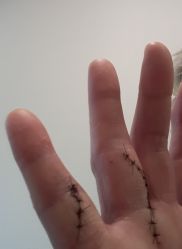 Durch einen Katzenbiss verletzte Hand. Nach einer Entzündung musste die Hand aufgeschnitten, gereinigt und genäht werden. (Bild: Karin Mayer-Kanal)
